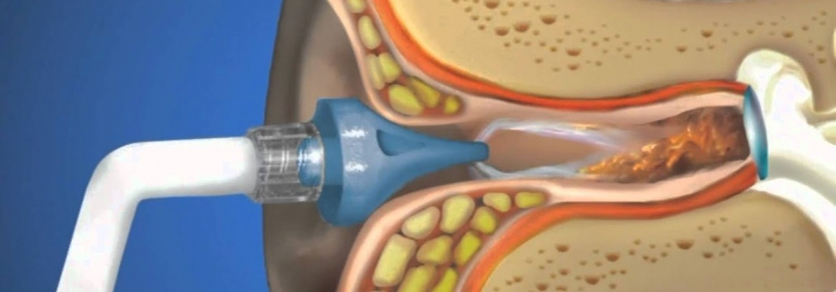 Bideford ear wax removal, Bideford ear syringing, Yelland ear syringing, Northam ear syringing, Merton ear syringing, High Bullen ear syringing,Bradworthy ear syringing, Hartland ear wax removal, Torrington ear syringing, Fremington ear syringing