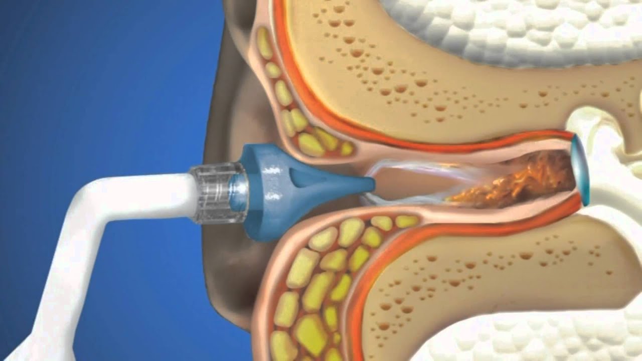 Bideford ear wax removal, Bideford ear syringing, Yelland ear syringing, Northam ear syringing, Merton ear syringing, High Bullen ear syringing,Bradworthy ear syringing, Hartland ear wax removal, Torrington ear syringing, Fremington ear syringing