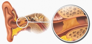 Bideford ear wax removal, Bideford ear syringing, Yelland ear syringing, Northam ear syringing, Merton ear syringing, High Bullen ear syringing,Bradworthy ear syringing